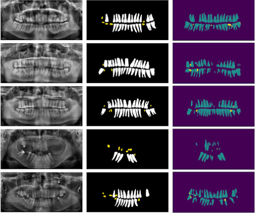 Dental Caries Segmentation for Panoramic X-Ray Images